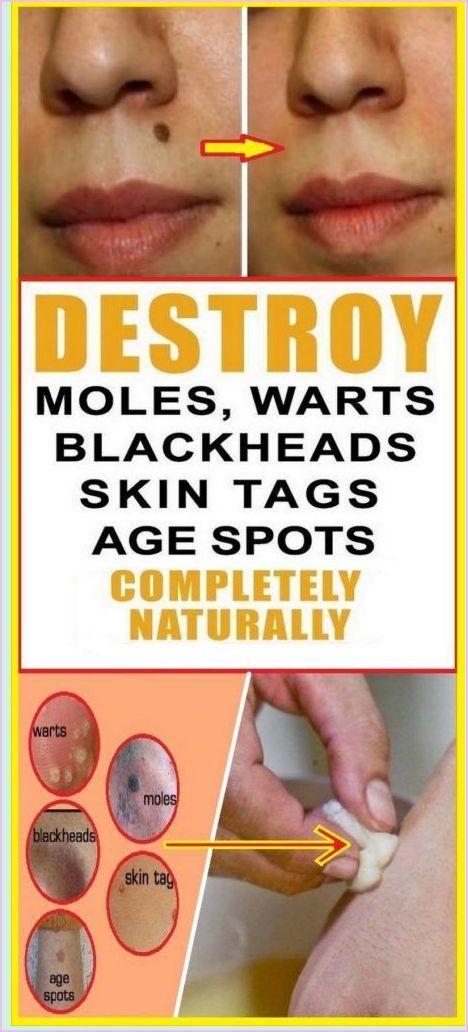 Natural Cure for Moles, Warts, Skin Tags, Age Spots and Blackheads