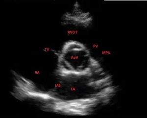 Parasternal short axis view , normal (transthoracic echocardiography) | Radiolog HD Wallpaper