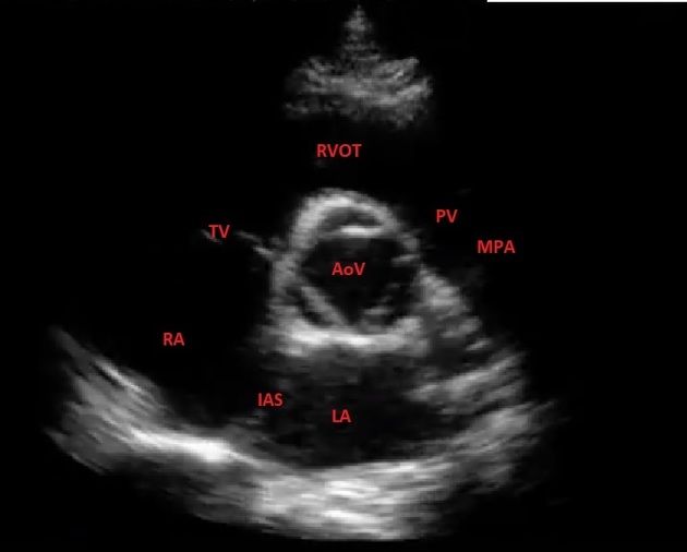 Parasternal Short Axis View - Normal (Transthoracic Echocardiography) | Radiolog