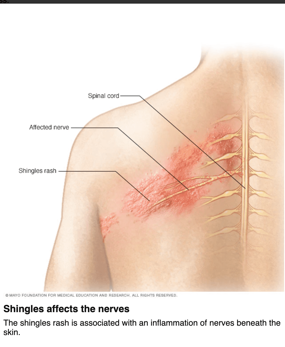 Postherpetic neuralgia from nerve damaged during Shingles