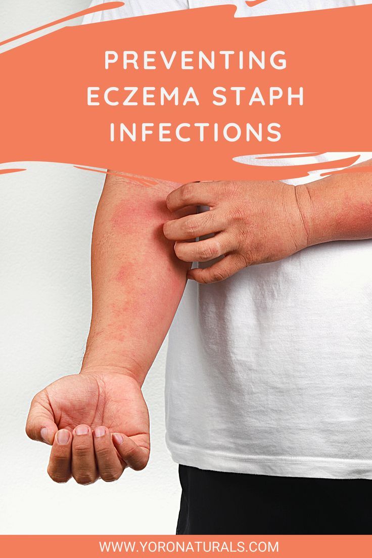 Preventing Eczema Staph Infections HD Wallpaper
