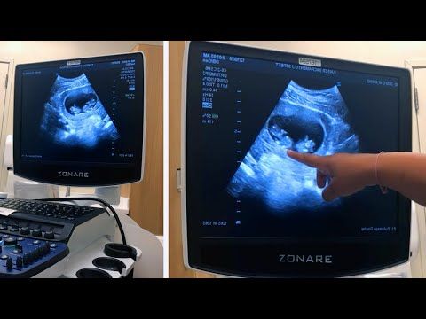 Surprise Ultrasound... Twins!? | Twins On Ultrasound Reaction!