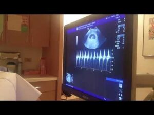 Six Weeks Ultrasound, Baby Heartbeat HD Wallpaper