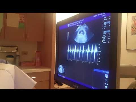 Six Weeks Ultrasound- Baby Heartbeat