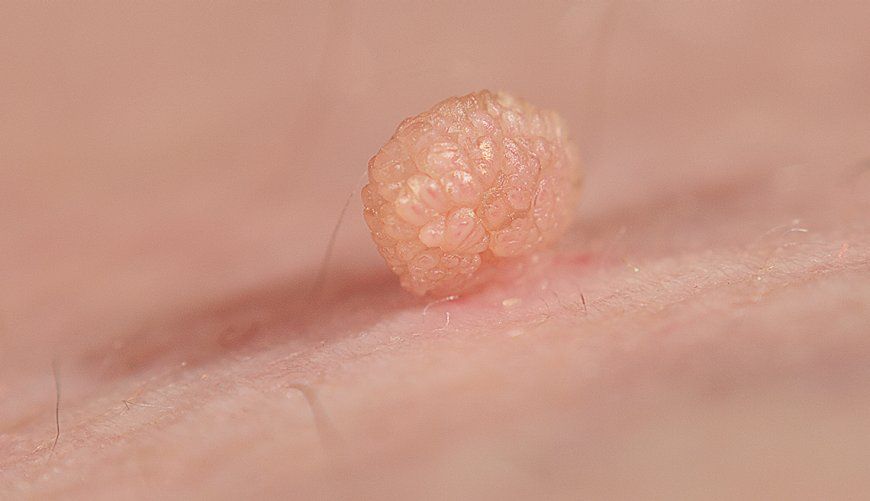 Skin Tags: What They Are and When You Should Remove Them