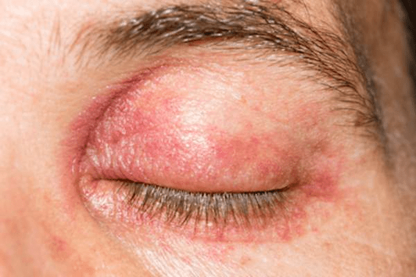 Surprising Facts About Shingles
