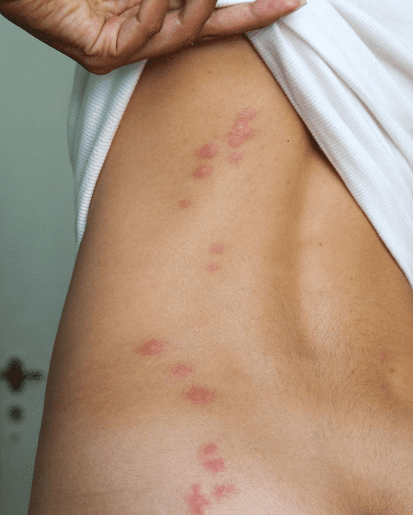 These Pictures Will Help You Id The Most Common Bug Bites And Their Symptoms