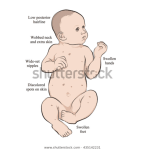 Turner Syndrome Turner Syndrome Symptoms Turner Stock Illustration 435142231 | S Images