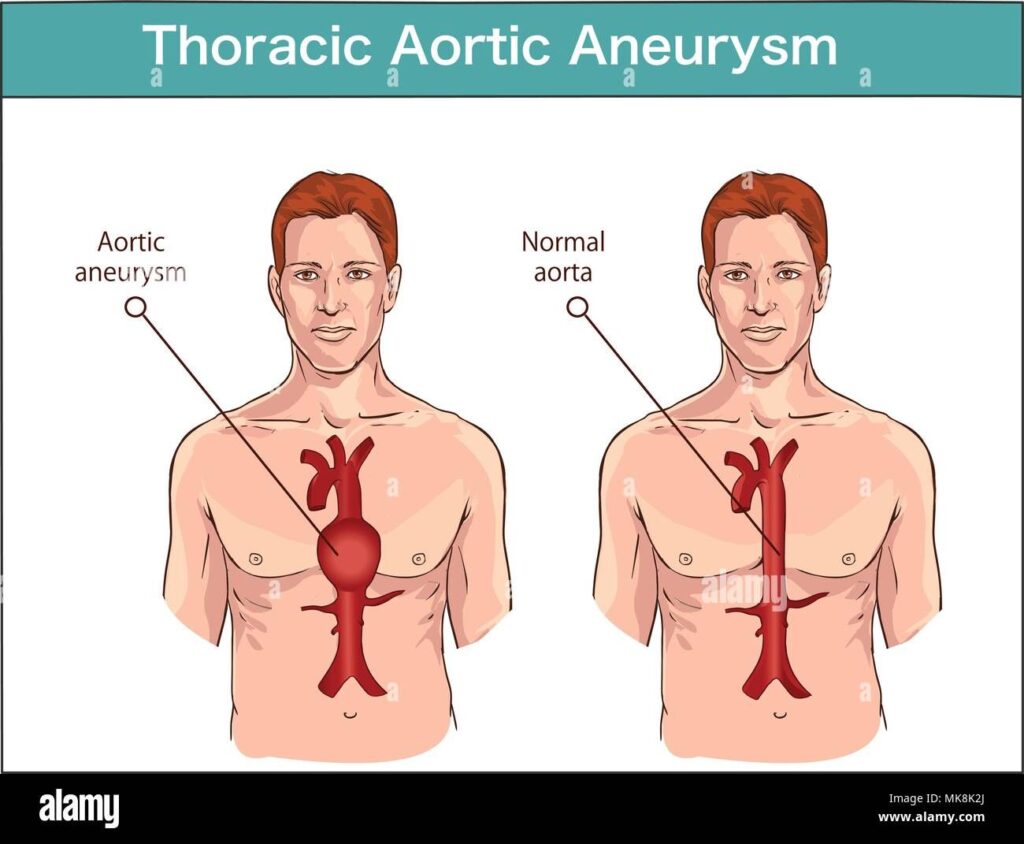 Types Of Abdominal Aortic Aneurysm. Normal Aorta And Enlarged Vessels. Vector Di