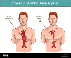 Types of abdominal aortic aneurysm. normal aorta , enlarged vessels. Vector di HD Wallpaper