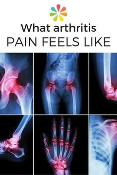 What Does Arthritis Pain Feel Like Images