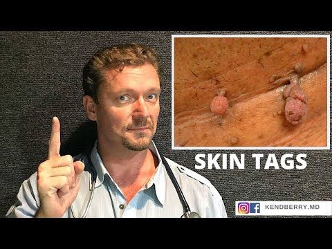 What SKIN TAGS Really Mean  (What Causes Skin Tags?)