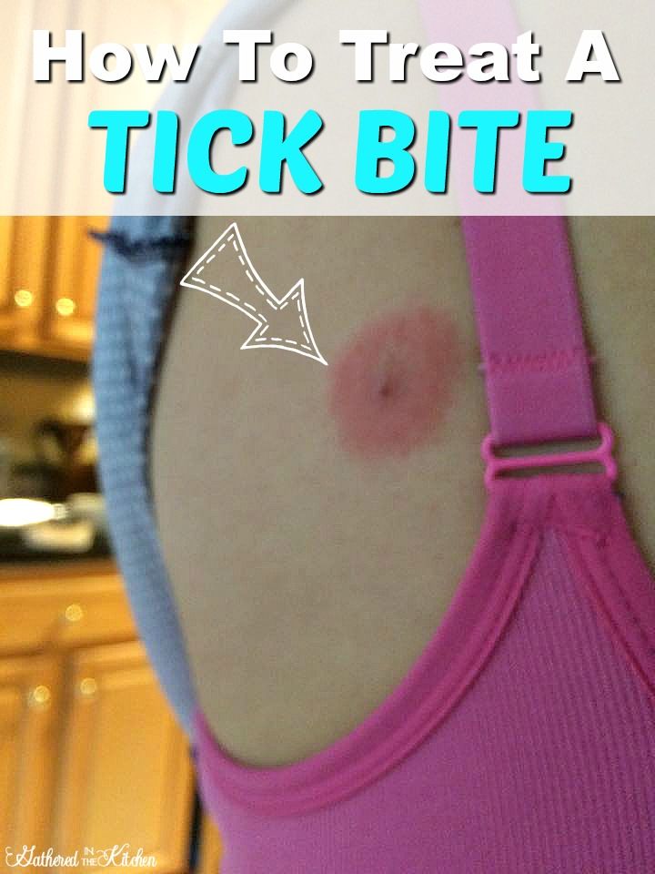 What To Do If You Get A Tick Bite