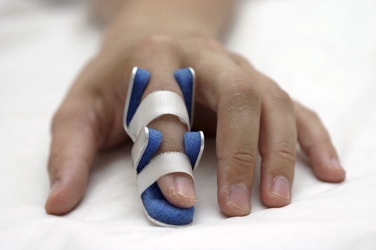 What You Should Do About a Broken Finger