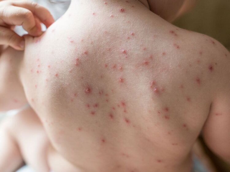 What Childhood Rash Is This Which Images