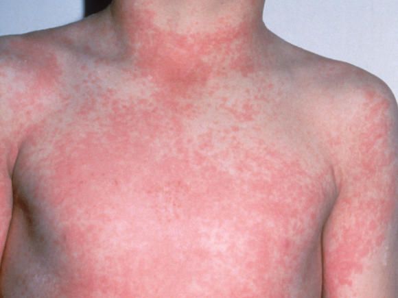 Pictures of childhood rashes: Red dots, bumps, and more