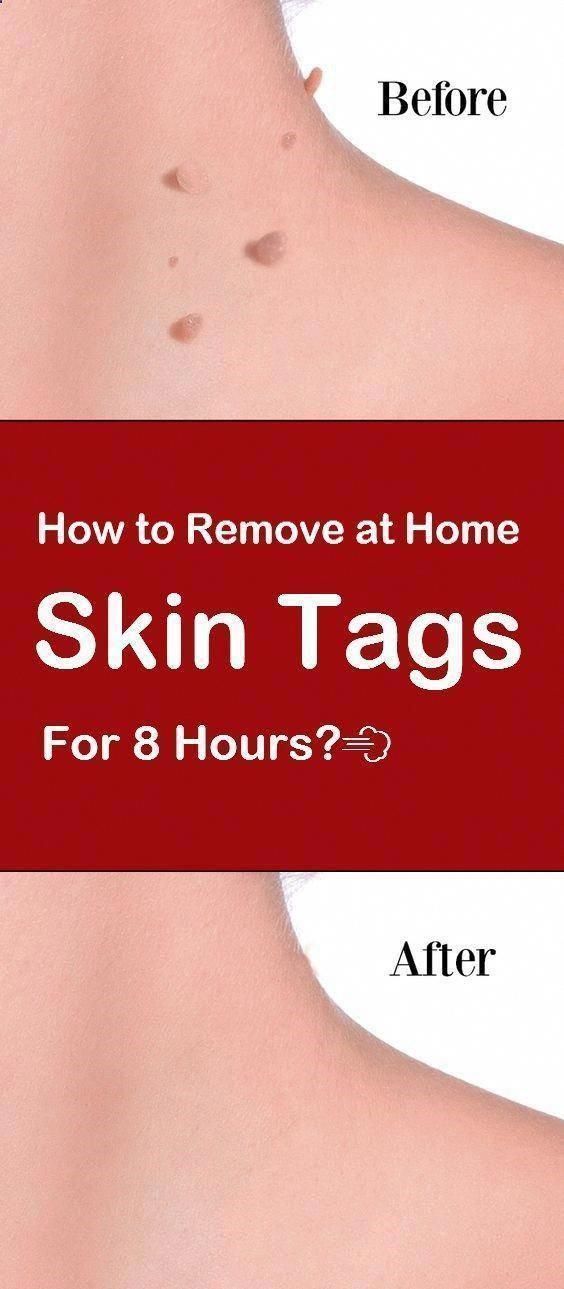 simple-ways-to-get-rid-of-skin-warts-easily